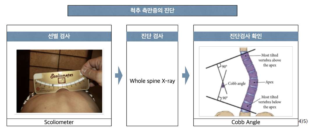 척추 측만증의 진단 과정